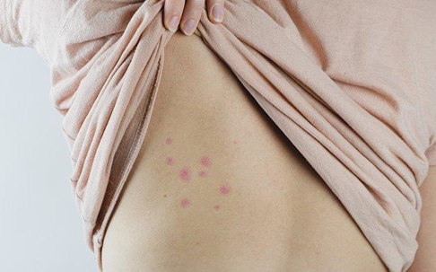 bed bug bites on skin