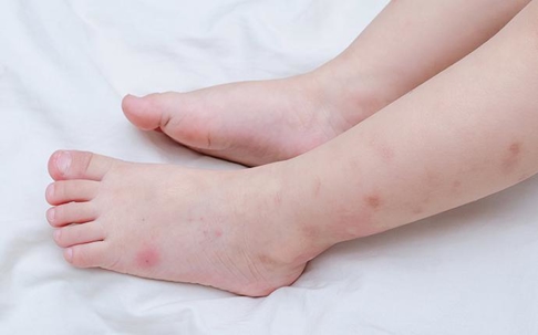 bed bug bites on a child's legs